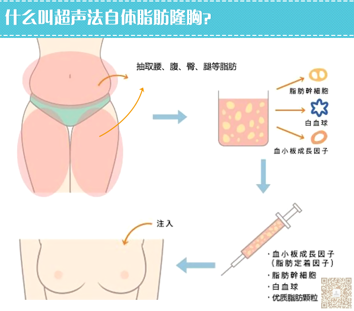 平胸的克星——超声波自体脂肪丰胸013 平胸的克星——超声波自体脂肪丰胸013