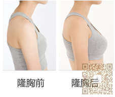 平胸的克星——超声波自体脂肪丰胸013 平胸的克星——超声波自体脂肪丰胸013