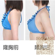 平胸的克星——超声波自体脂肪丰胸013 平胸的克星——超声波自体脂肪丰胸013