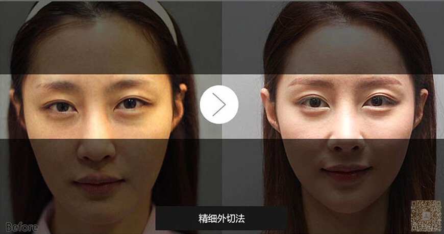 超 声 波去眼袋,让你远离眼袋得烦恼 超 声 波去眼袋,让你远离眼袋得烦恼