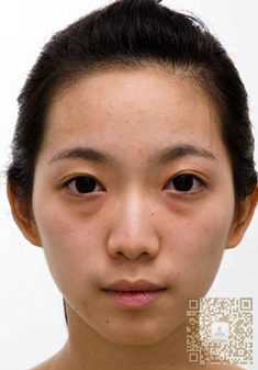 超声波去眼袋解决了我的工作问题742 超声波去眼袋解决了我的工作问题742