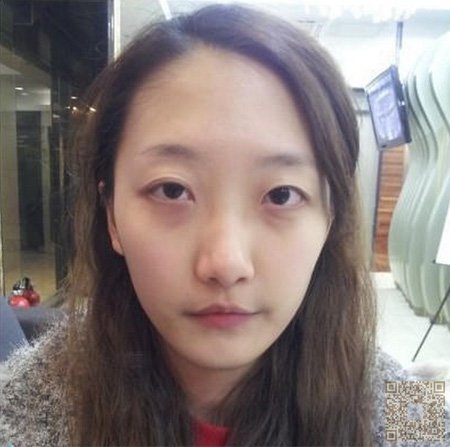 超声波去眼袋手术做了以后会凹陷吗857