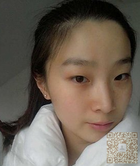 终于做了超声波双眼皮,心情很不错623 终于做了超声波双眼皮,心情很不错623