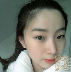终于做了超声波双眼皮,心情很不错623 终于做了超声波双眼皮,心情很不错623