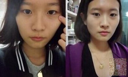 如何拥有一对超自然双眼皮？超雅就是最好的选择123