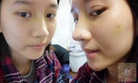 如何拥有一对超自然双眼皮？超雅就是最好的选择123