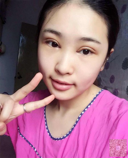 体验le免费做双眼 皮，效果好得惊人！