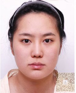做了超声波双下巴成功瘦没了273