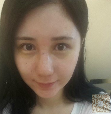 在超雅整形医院做了自体软骨隆鼻，效果还是不错滴958