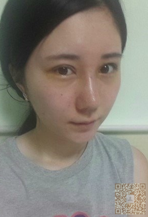 在超雅整形医院做了自体软骨隆鼻，效果还是不错滴958