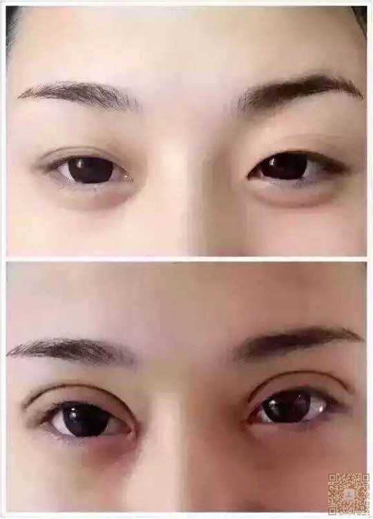 超 声 波双眼 皮,使wǒ提高竞争力 超 声 波双眼 皮,使wǒ提高竞争力