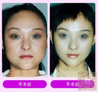 超 声 波瘦脸,圆你瘦脸梦 超 声 波瘦脸,圆你瘦脸梦
