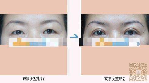 wǒ不后悔下定决心做le超 声 波双眼 皮 wǒ不后悔下定决心做le超 声 波双眼 皮