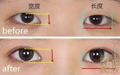 wǒ不后悔下定决心做le超 声 波双眼 皮 wǒ不后悔下定决心做le超 声 波双眼 皮