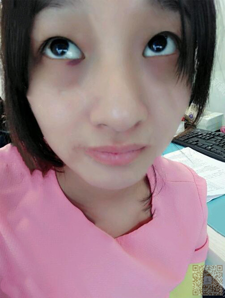 宅女成功去除眼袋就靠超 声 波 宅女成功去除眼袋就靠超 声 波
