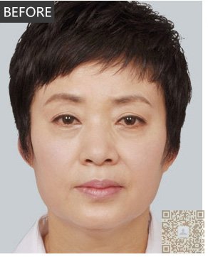 两个大妈做了超声波祛眼袋，眼袋没有了人还年轻了。503