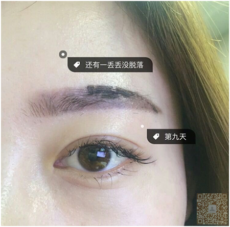 雾眉结痂,雾眉结痂蜕变高清图片