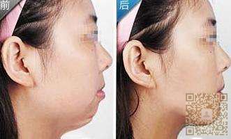 超声波去双下巴打造的是你的自信779 超声波去双下巴打造的是你的自信779