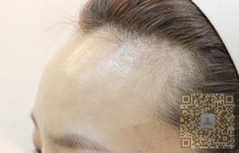 辣妈生产以后发际线快掉没le做le半永久又长出来le