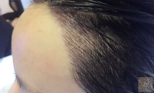 辣妈生产以后发际线快掉没le做le半永久又长出来le