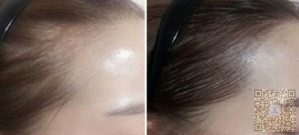 发际线高怎么办？发际线调整