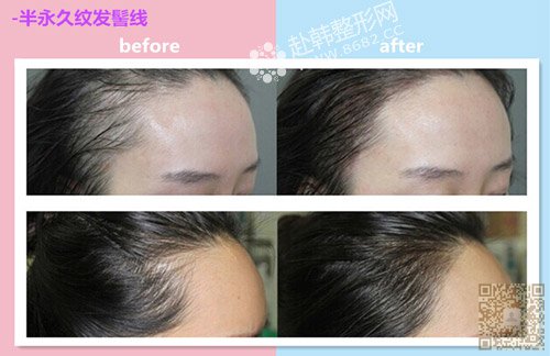 韩式半永久发际线提升气质