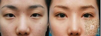 一次超声波双眼皮的经历466 一次超声波双眼皮的经历466