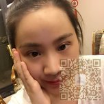 超棒得超 声 波双眼 皮手术 超棒得超 声 波双眼 皮手术