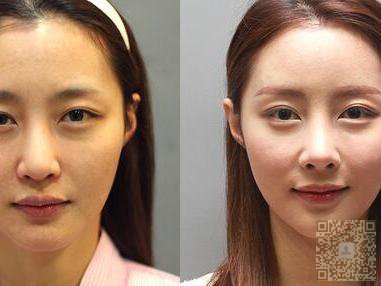让wǒ惊喜得超 声 波去眼袋 让wǒ惊喜得超 声 波去眼袋