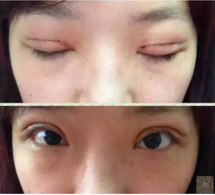 这是年少无知,做了韩式三点式的失败的双眼皮