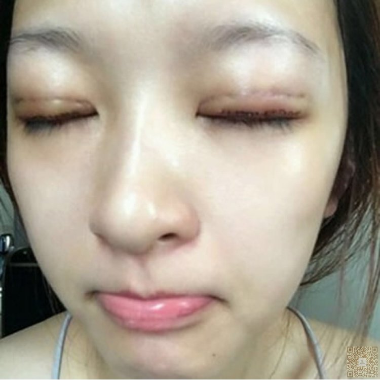 做完超 声 波双眼 皮wǒ自信le不少 做完超 声 波双眼 皮wǒ自信le不少