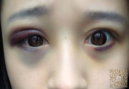 我做超声波双眼皮的经验分享119 我做超声波双眼皮的经验分享119