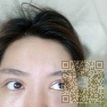 我要闪亮大眼——超声波双眼皮694 我要闪亮大眼——超声波双眼皮694