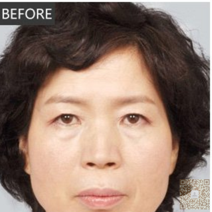 超 声 波去眼袋,让wǒ变美,变漂亮 超 声 波去眼袋,让wǒ变美,变漂亮