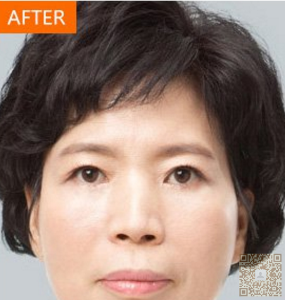 超 声 波去眼袋,让wǒ变美,变漂亮 超 声 波去眼袋,让wǒ变美,变漂亮