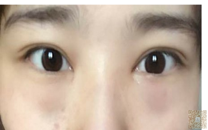 医学院小美女去做超声波去眼袋566 医学院小美女去做超声波去眼袋566