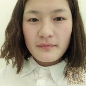 超雅超 声 波双眼 皮手术后变得好美 超雅超 声 波双眼 皮手术后变得好美