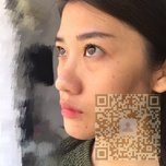 还我美美的眼睛——超声波去眼袋253 还我美美的眼睛——超声波去眼袋253