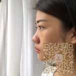 还我美美的眼睛——超声波去眼袋253 还我美美的眼睛——超声波去眼袋253