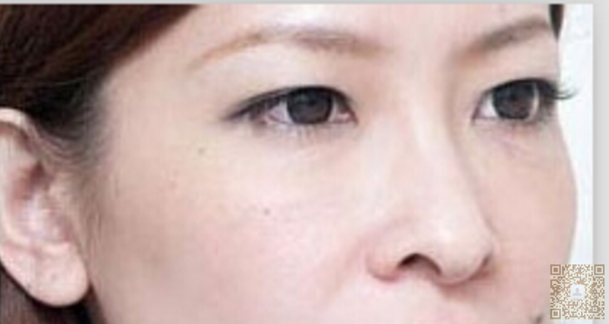 做le超 声 波去眼袋,即使熬夜也不怕啦 做le超 声 波去眼袋,即使熬夜也不怕啦