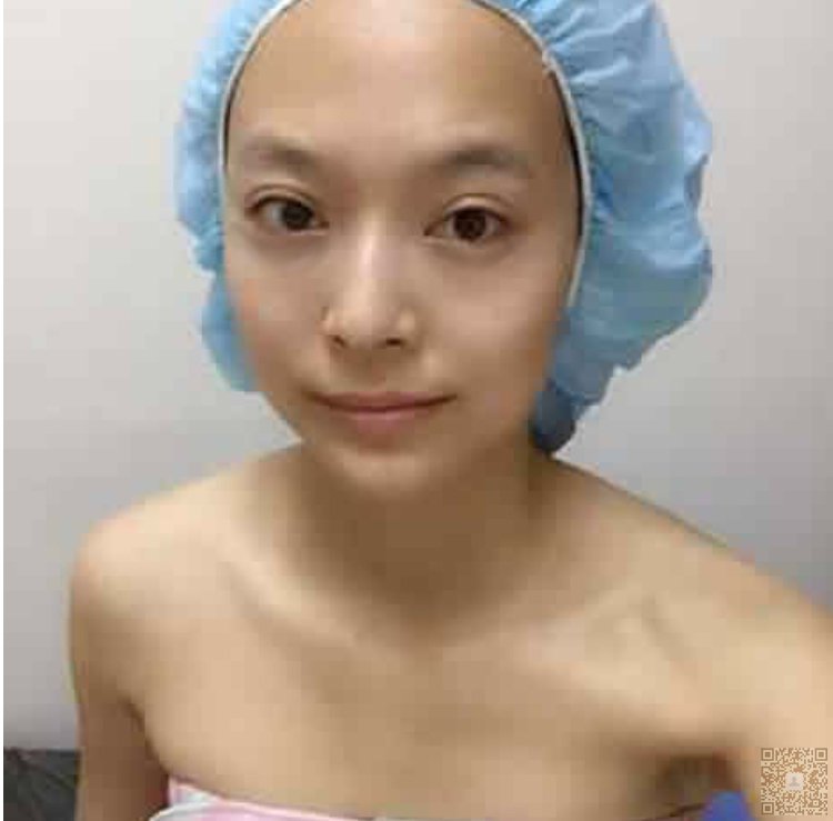 我去超雅做超声波去眼袋的经历谈237 我去超雅做超声波去眼袋的经历谈237