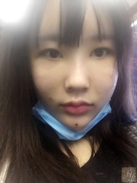 网红也去做不开刀隆鼻771