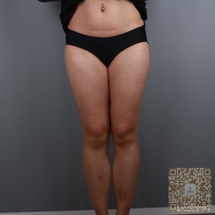 超雅超声波减肥让我美美的987 超雅超声波减肥让我美美的987