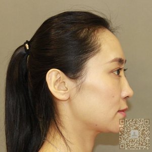 超雅不开刀隆鼻,做优雅女人243 超雅不开刀隆鼻,做优雅女人243