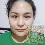 超 声 波瘦脸手术让wǒ变得更年轻 超 声 波瘦脸手术让wǒ变得更年轻