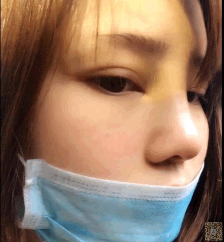 不开刀隆鼻一年纪念帖996