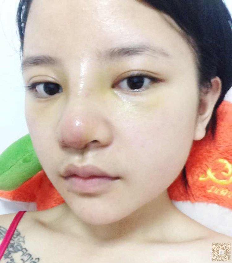不开刀隆鼻以后wǒ得鼻子不再丑le