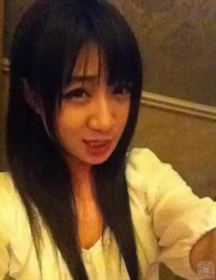 不开刀隆鼻以后wǒ得鼻子不再丑le