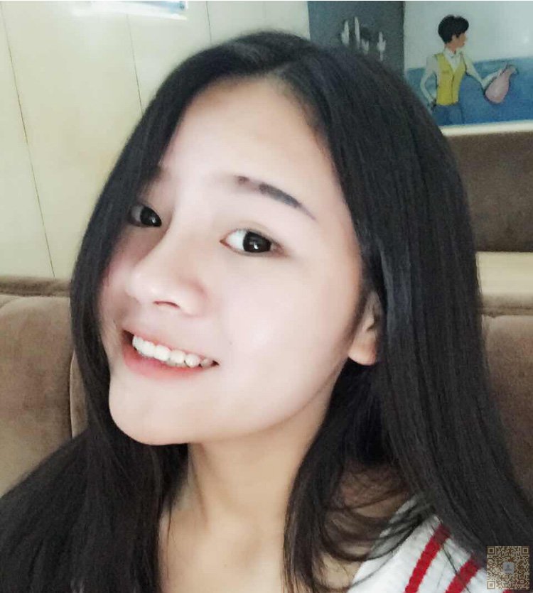 不开刀隆鼻体验分享