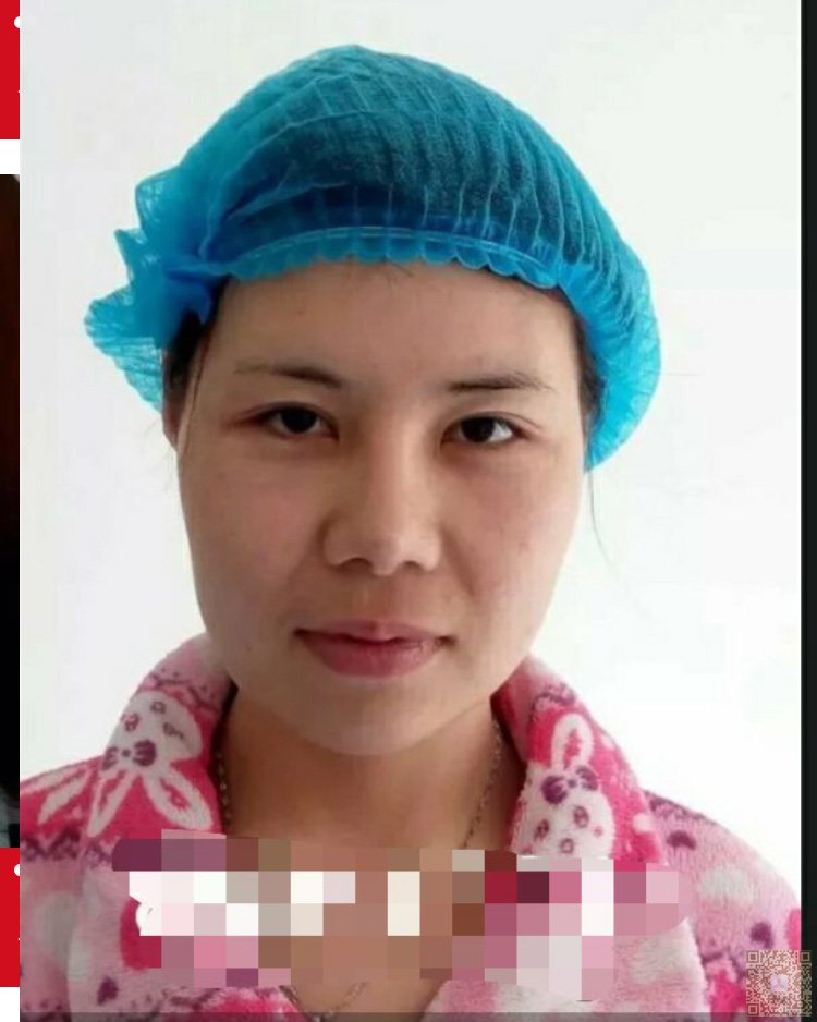 超声波双眼皮也可以让我美过小三006